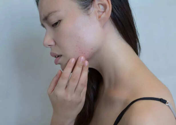 pregnant woman with acne