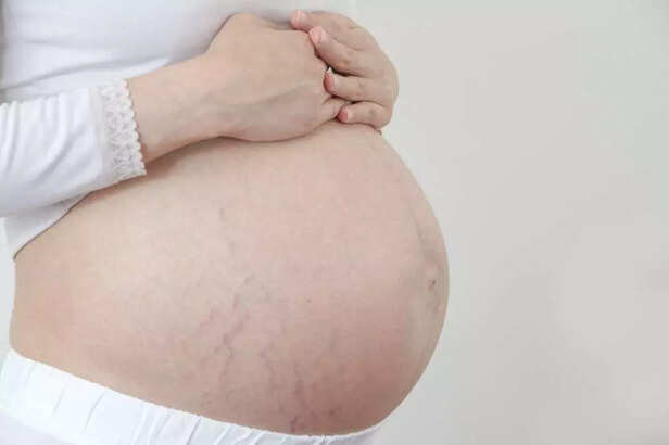 Pregnancy Stretch Marks