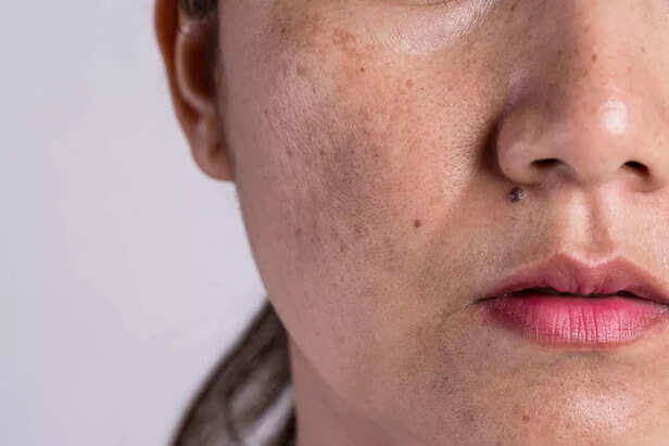 skin pigmentation